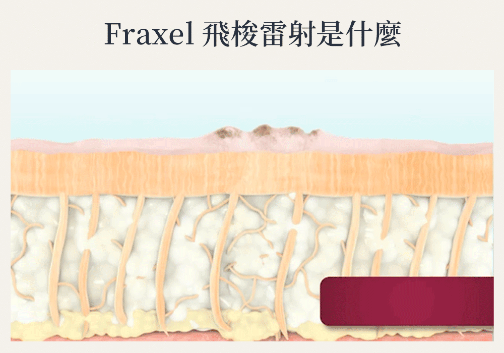 Fraxel飛梭雷射