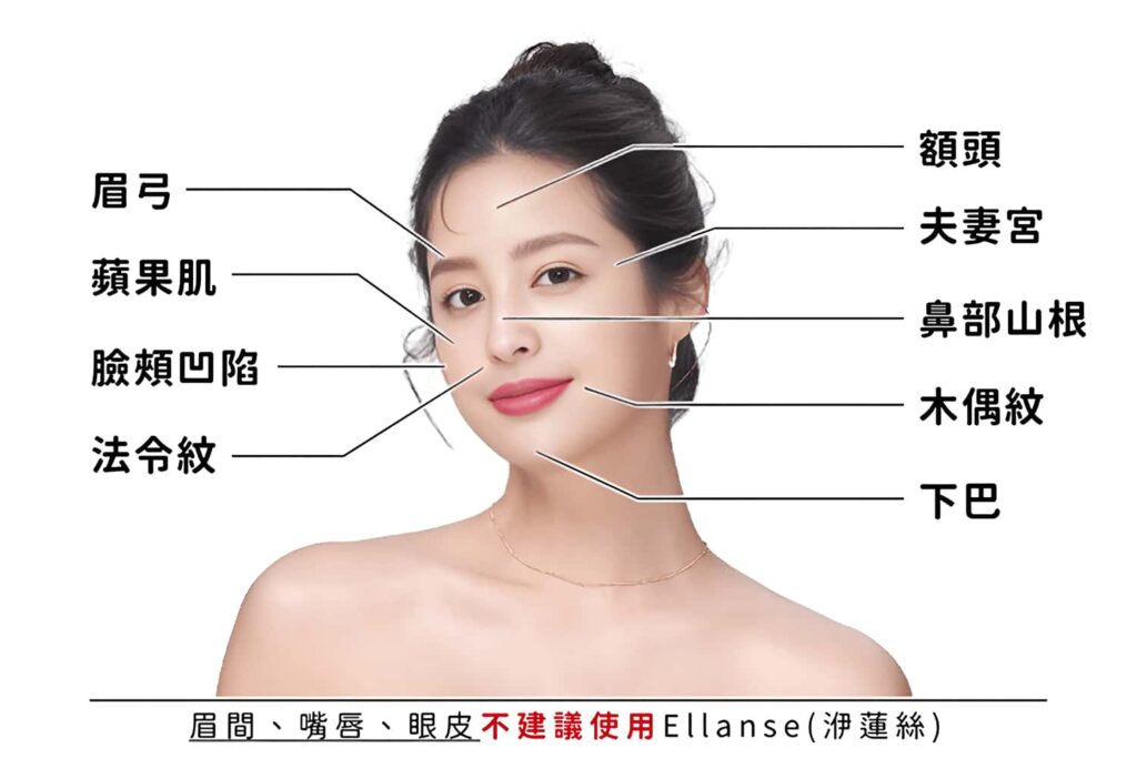 Ellanse-洢蓮絲可治療部位