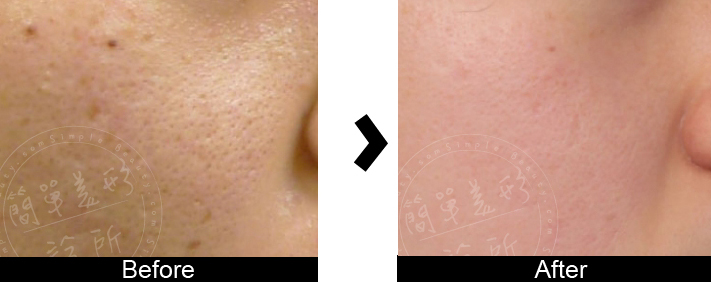 Co2飛梭雷射案例11