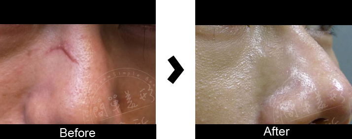 Co2飛梭雷射案例7