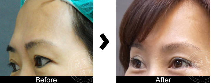 上額提眉術案例2-2