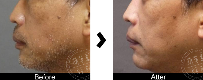 上額提眉術案例5