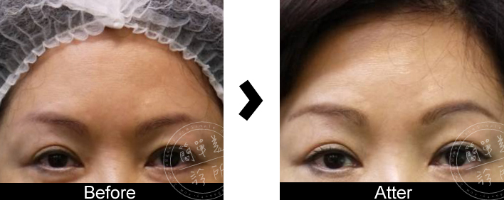 上額提眉術案例6