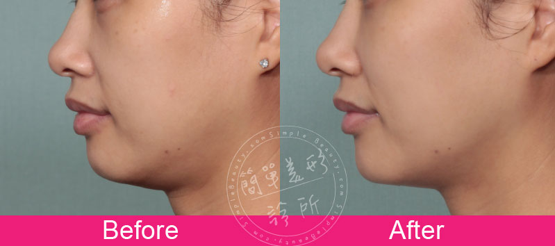 下巴 案例分享8