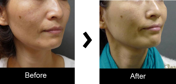 印第安文法令紋治療