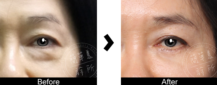 外開式眼袋案例2