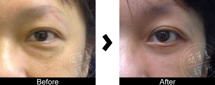 外開式眼袋案例8