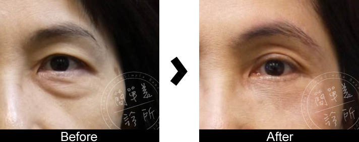 外開式眼袋案例9