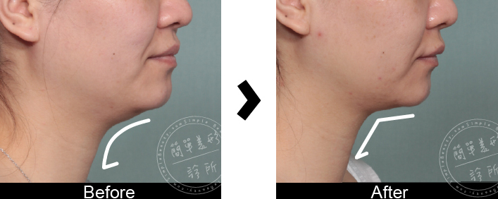 消脂針案例5