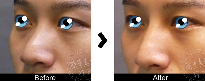 玻尿酸鼻小柱＋微晶瓷山根隆鼻