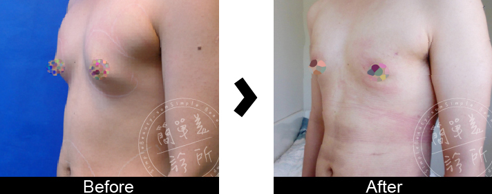 男性女乳症手術案例1-1