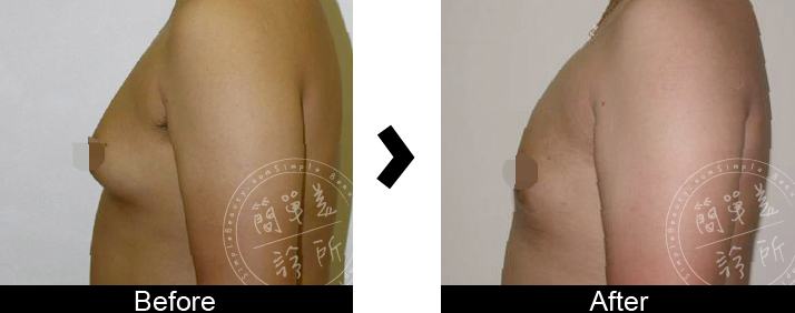 男性女乳症手術案例2-1