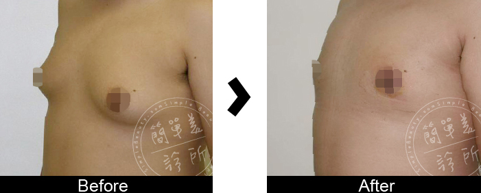 男性女乳症手術案例2