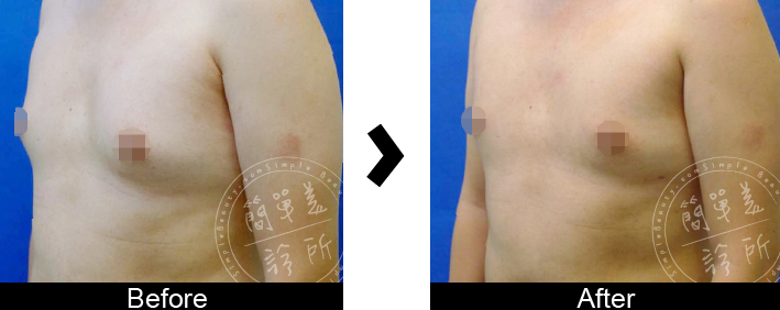 男性女乳症手術案例3