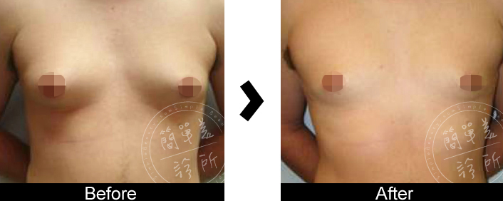 男性女乳症手術案例4