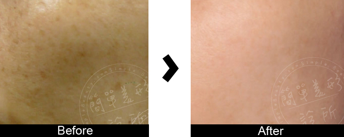 皮秒雷射案例10