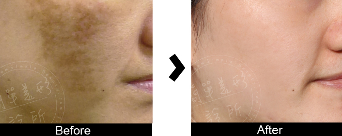 皮秒雷射案例11