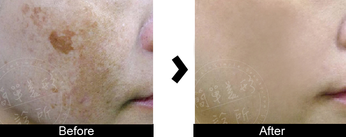 皮秒雷射案例12