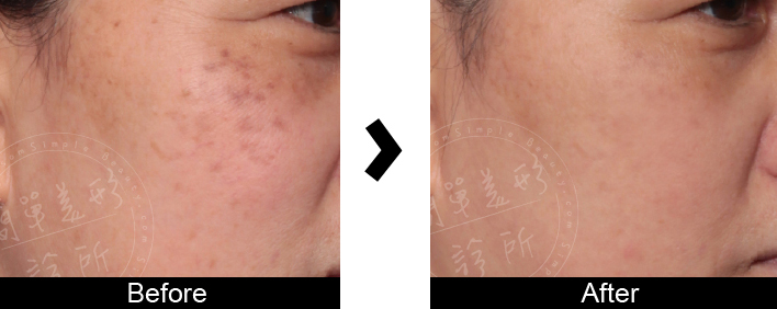 皮秒雷射案例13