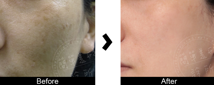 皮秒雷射案例14