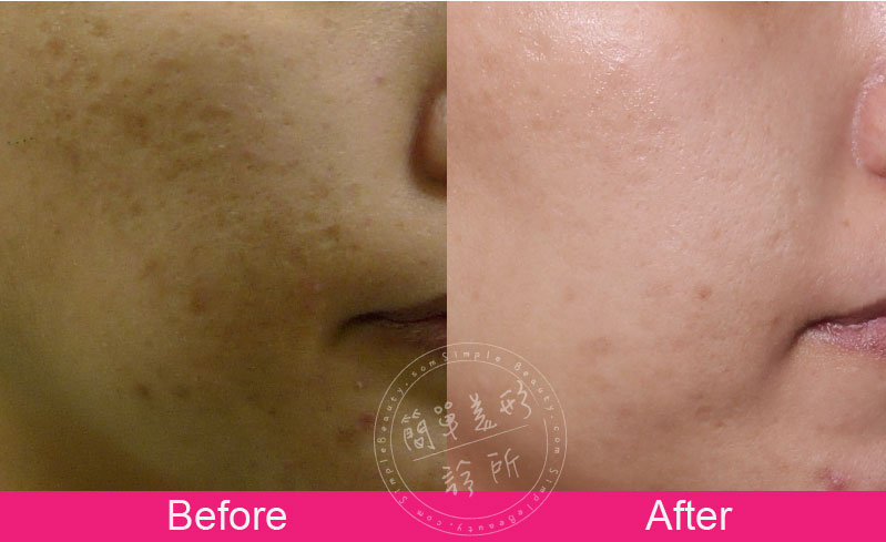 綜合改善成年案例分享9