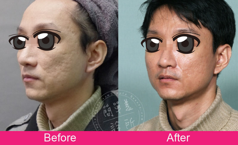 膠原蛋白增生劑 案例分享1