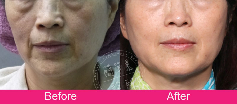 膠原蛋白增生劑 案例分享10