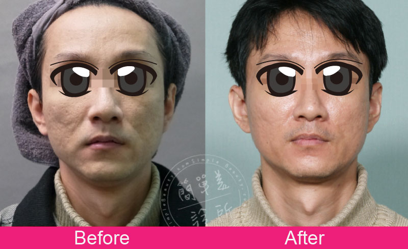 膠原蛋白增生劑 案例分享2