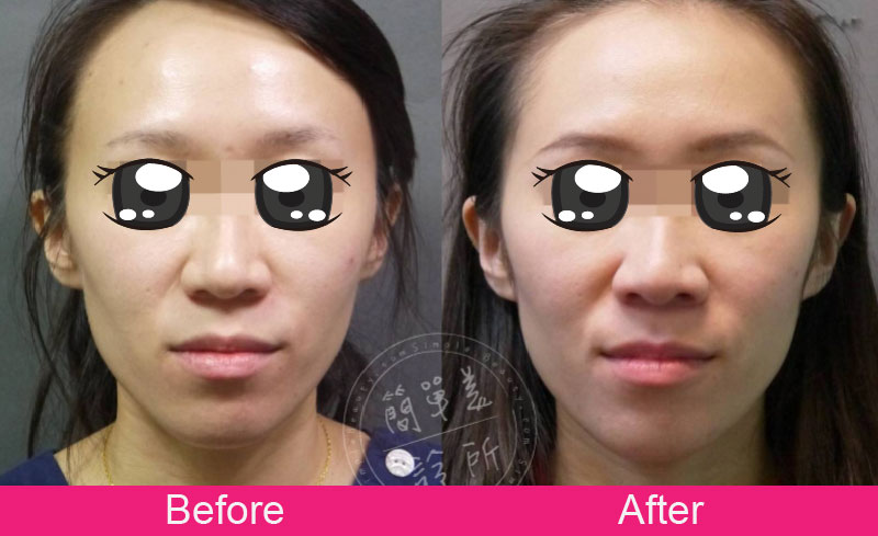 膠原蛋白增生劑 案例分享3