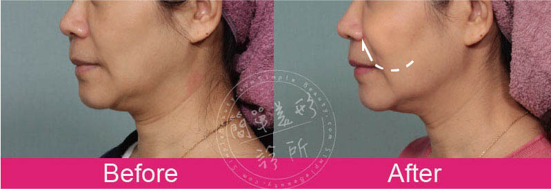 膠原蛋白增生劑 案例分享6