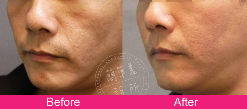 膠原蛋白增生劑 案例分享7