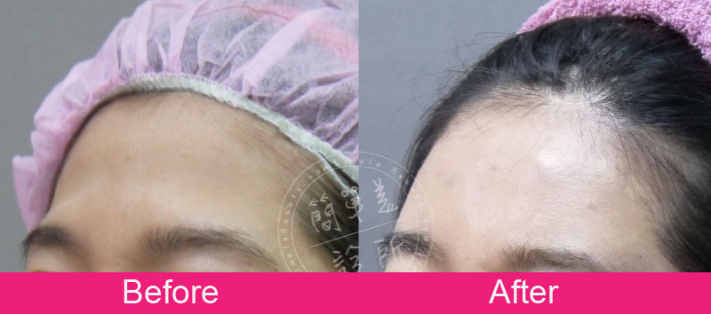 膠原蛋白增生劑 案例分享8