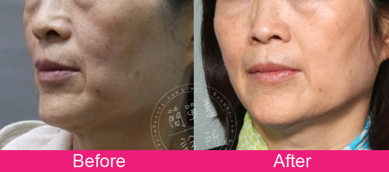 膠原蛋白增生劑 案例分享9