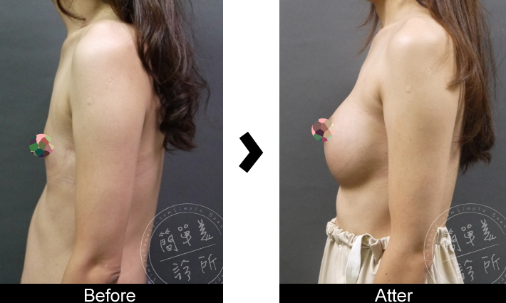 隆乳手術案例13