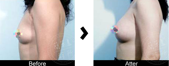 隆乳手術案例5