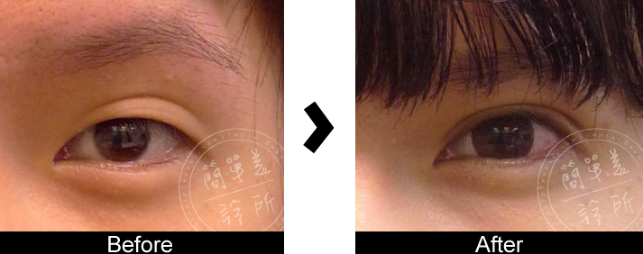 雙眼皮手術案例10
