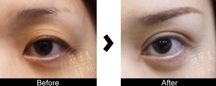雙眼皮手術案例14