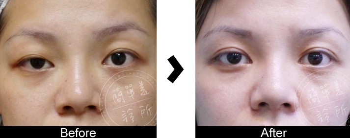雙眼皮手術案例16