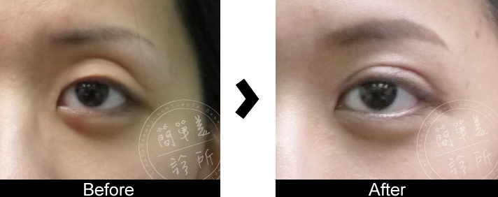 雙眼皮手術案例17