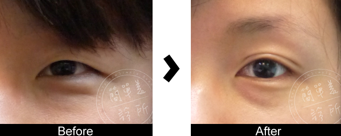 雙眼皮手術案例4