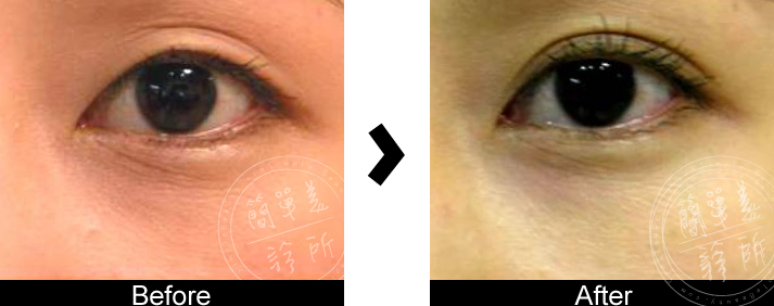 雙眼皮手術案例5