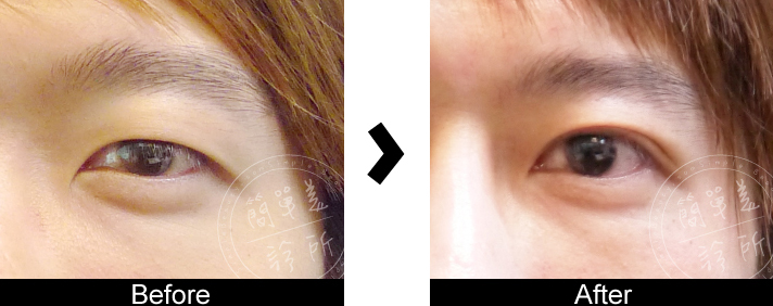 雙眼皮手術案例8