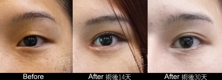雙眼皮開眼頭1