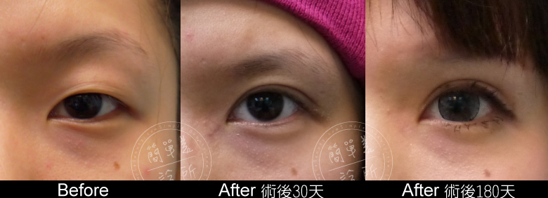 雙眼皮開眼頭5
