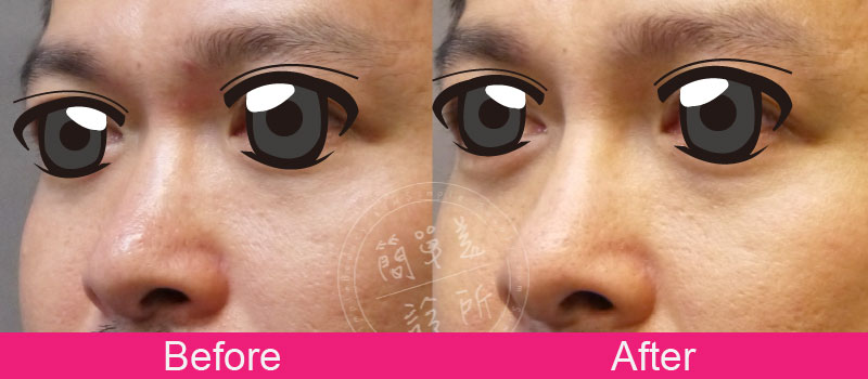 鼻子 案例分享15