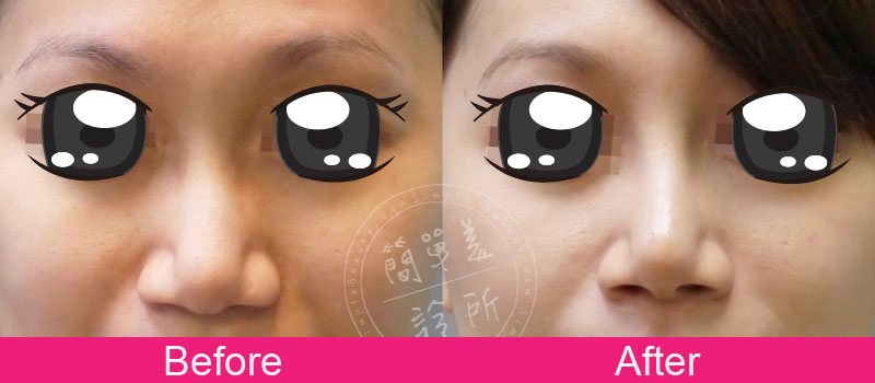 鼻子 案例分享16