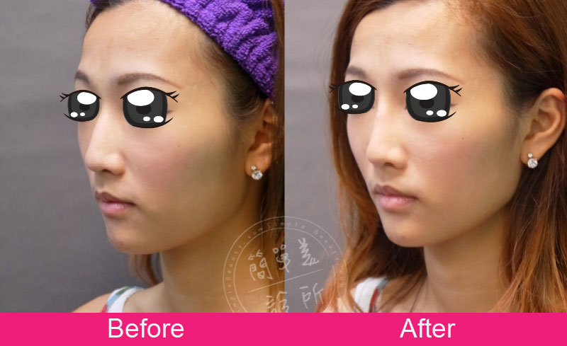 鼻子 案例分享19