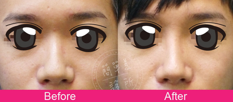 鼻子 案例分享5