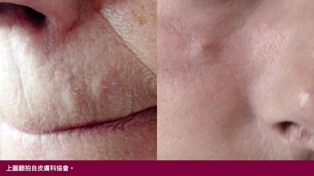 舒顏萃後遺症-肉芽腫