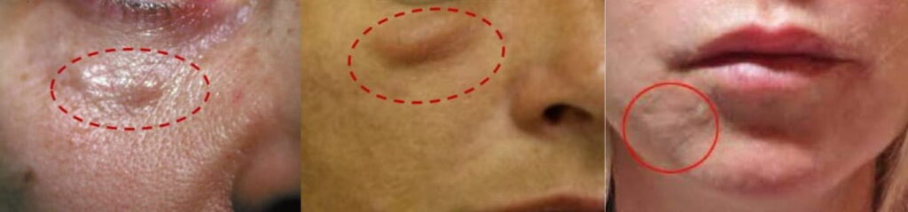 舒顏萃施打後遺症